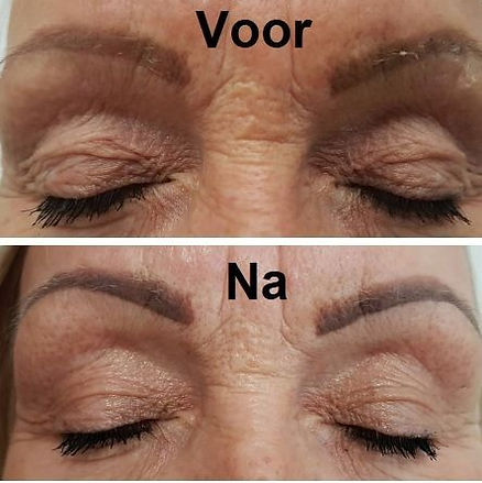 Voor en na resultaten met de plasma behandeling met de Plasmagun