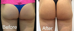 Butt Lift Before & After Pics