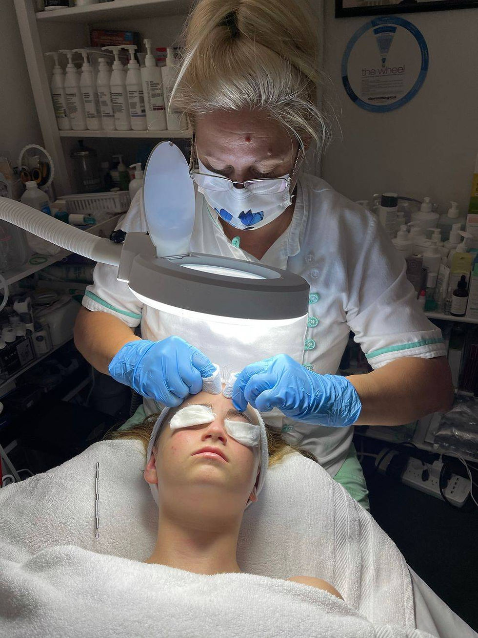 Teen Acne Treatment