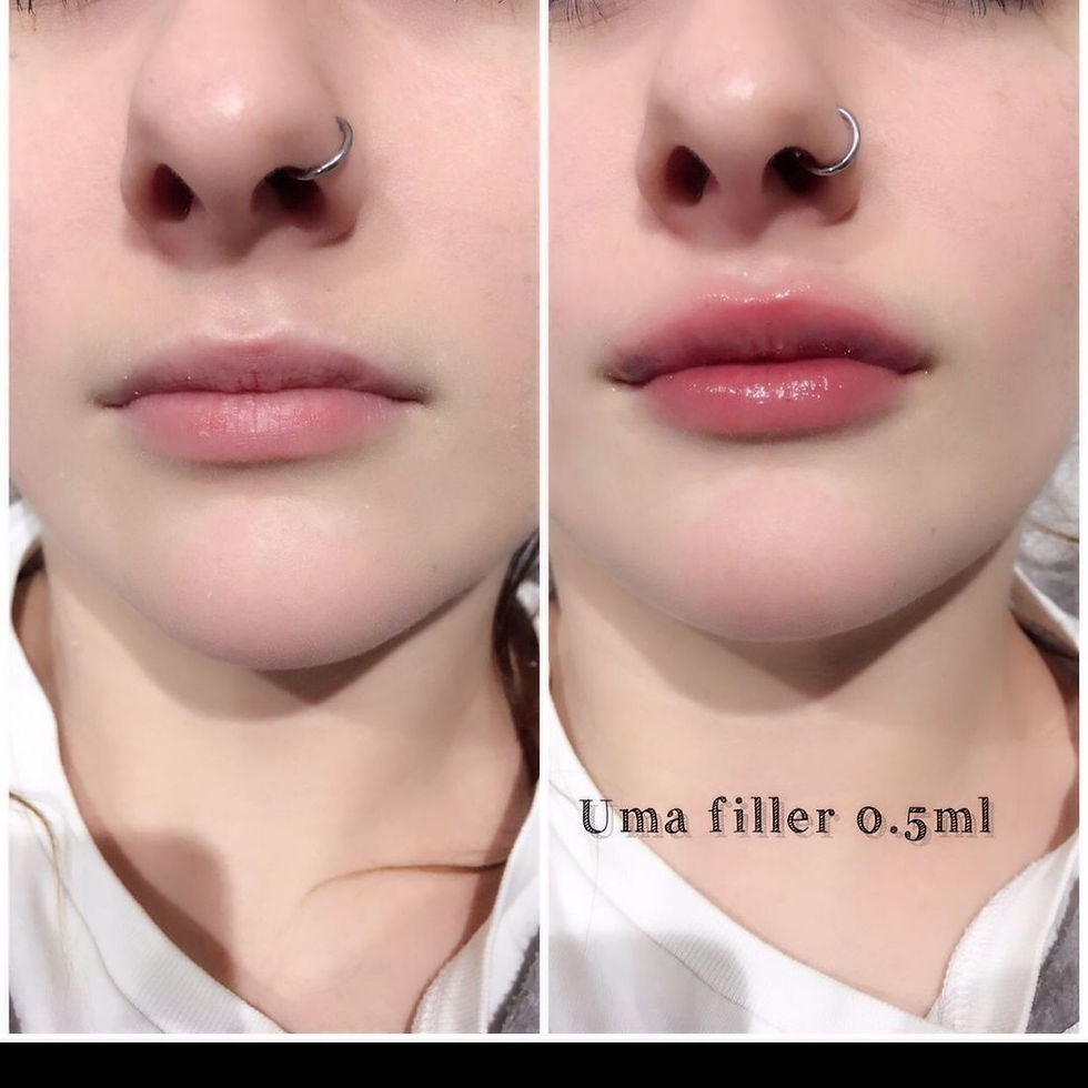 0.5ML LIP FILLER