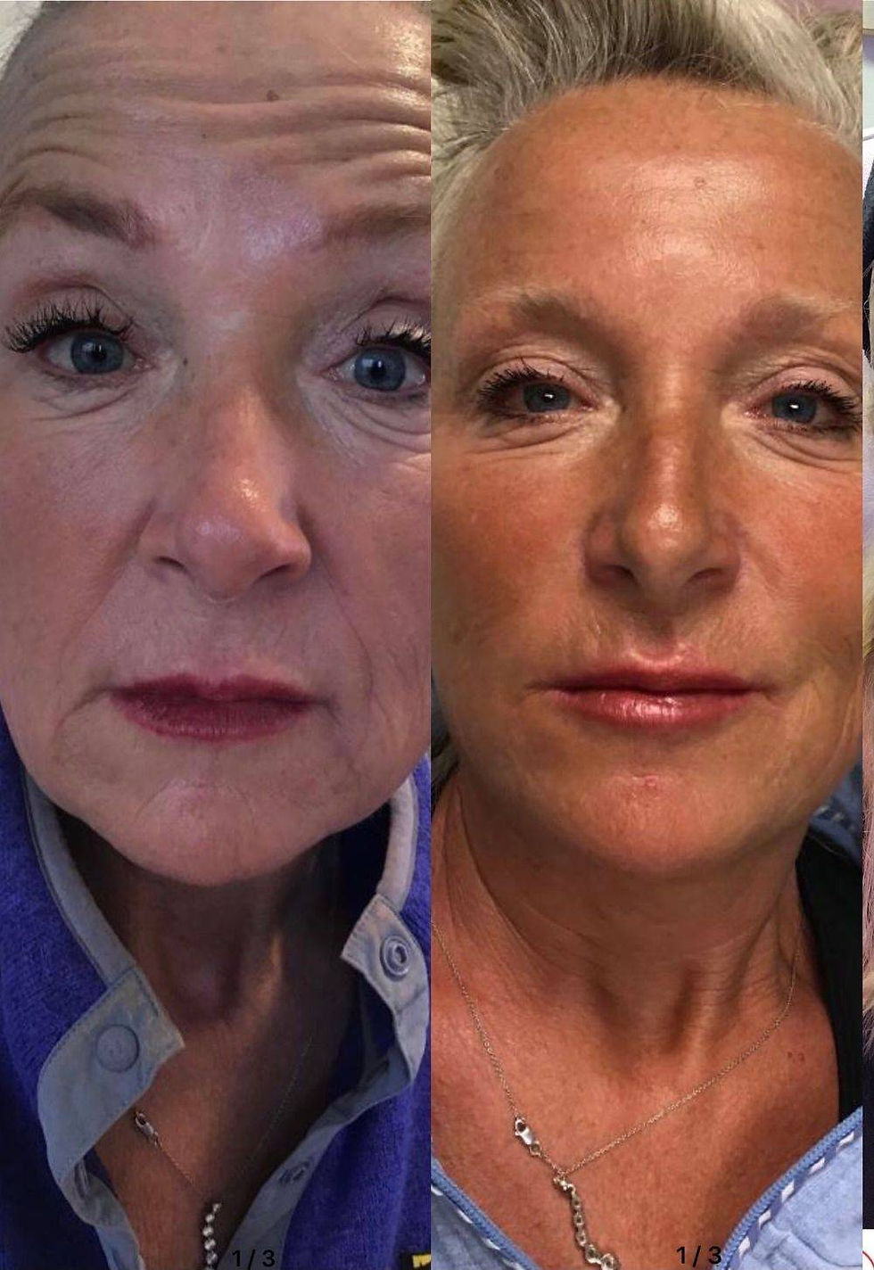PRP Facial Rejuvination, Botox, Filler, Ultherapy