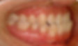 Underbite