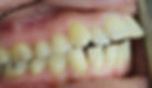 Dental Protrusion