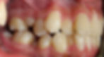 Dental Crowding