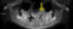 Impacted Tooth