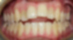 Open Bite