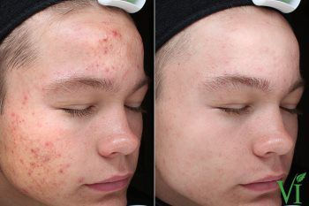 acne scar