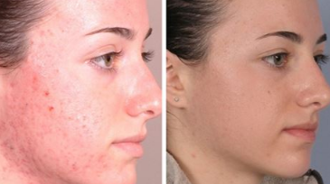 Best-chemical-peel-for-acne-scars 1