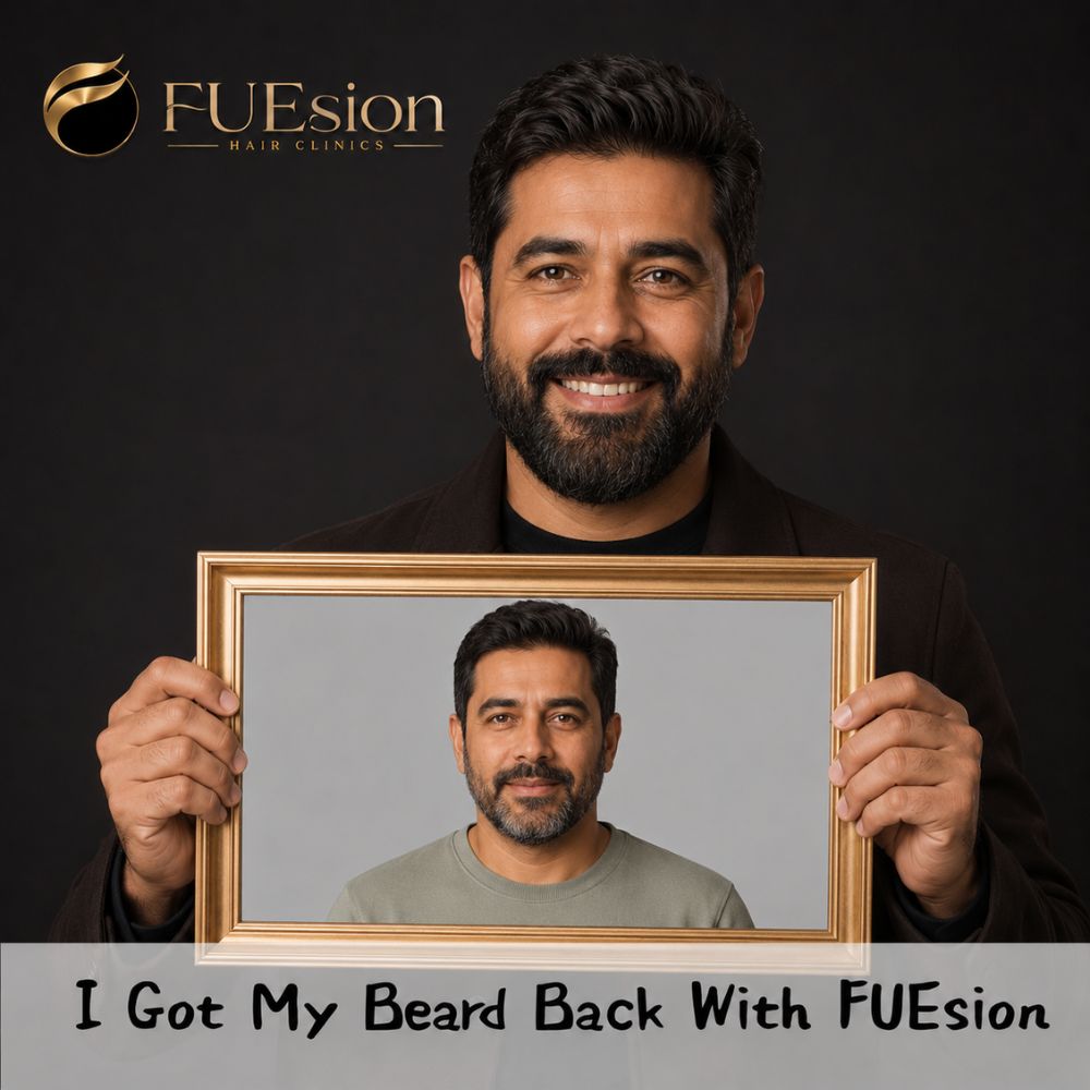 Beard transplant patient result — goatee and jawline restoration, FUEsion Hair Clinics