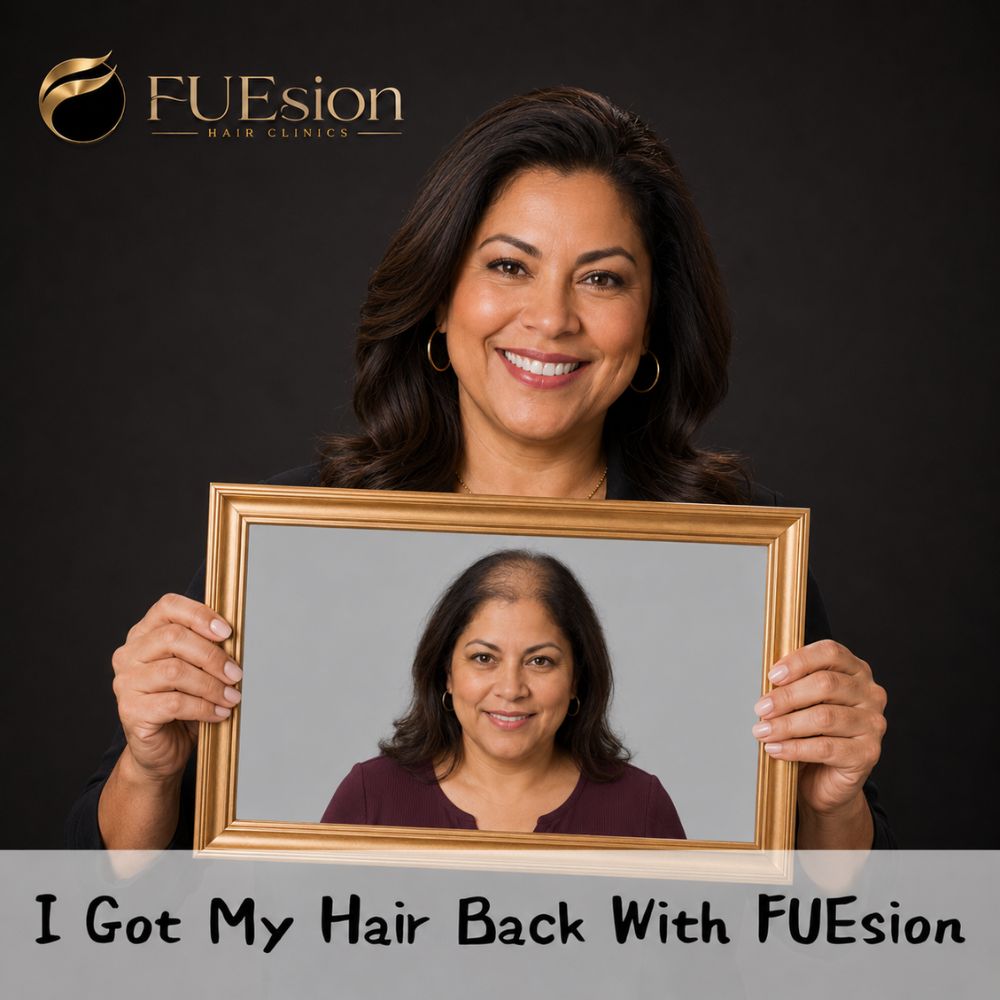 Female hair transplant result — FUEsion Hair Clinics