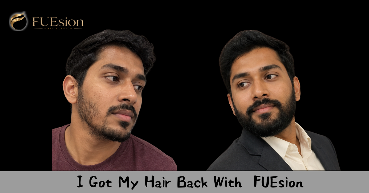 Beard Transplant Before & After — FUEsion Patient