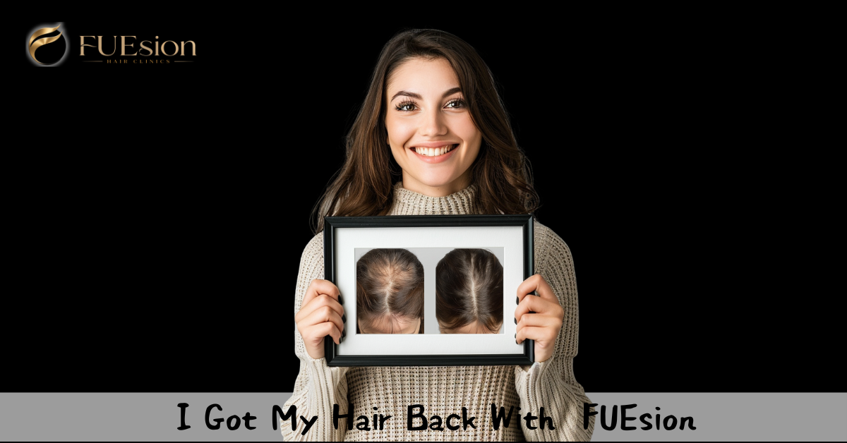 Female Hair Transplant Before & After — FUEsion Patient