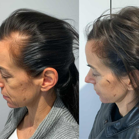 Female Hair Transplant Result Before And After - FUEsion Hair Clinics