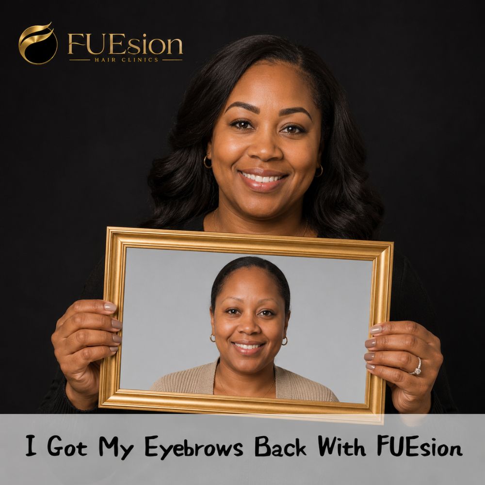 Eyebrow transplant patient result — precise angle placement, FUEsion Hair Clinics