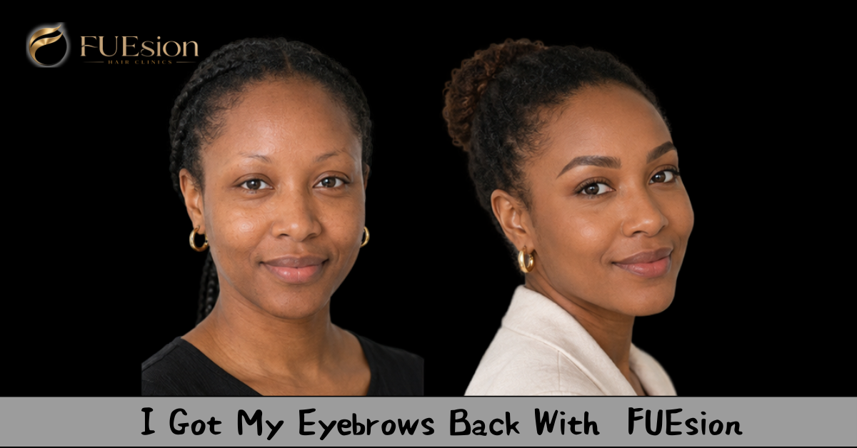 Eyebrow Transplant Before & After — FUEsion Patient