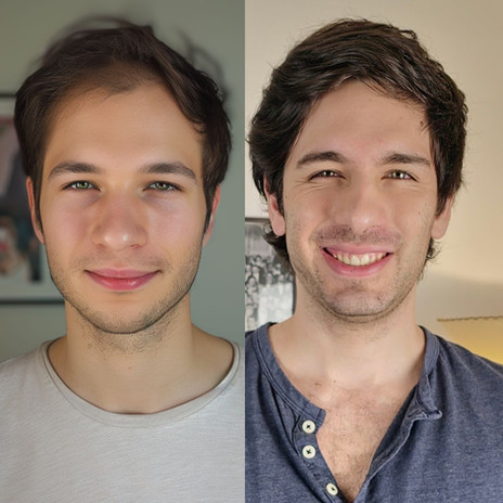 Best Hair Transplant in Los Angeles - Hair Transplant Before And After Result
