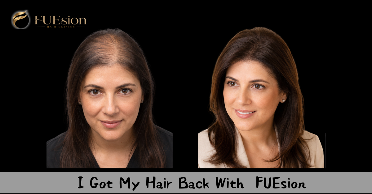InFuze Non-Surgical Before & After — FUEsion Patient
