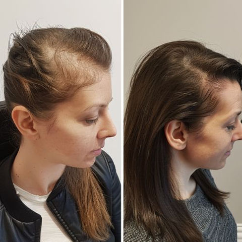 Female Hair Transplant Result Before And After - FUEsion Hair Clinics