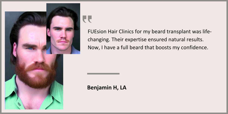 FUEsion Hair Clinics - Beard Transplant Testimonial