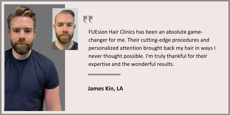 Hair Transplant in Beverly Hills - Male Hair Transplant Testimonial