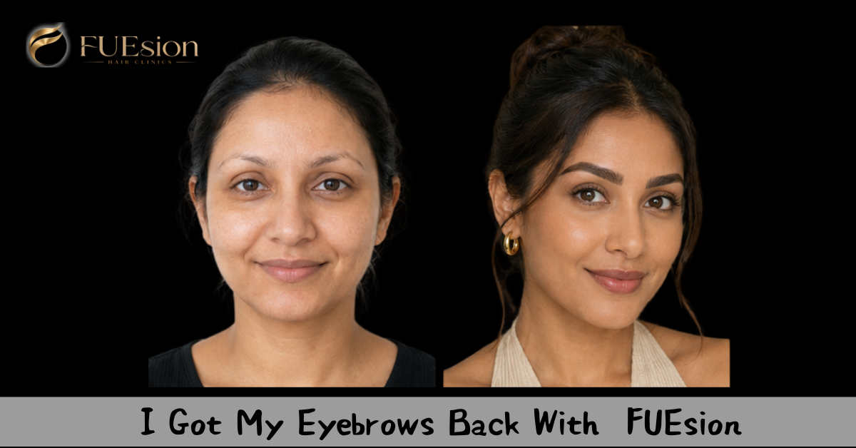 Eyebrow Transplant Before & After — FUEsion Patient