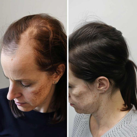 Female Hair Transplant Result Before And After - FUEsion Hair Clinics