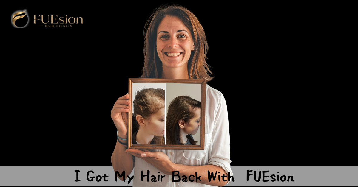 Female Hair Transplant Before & After — FUEsion Patient