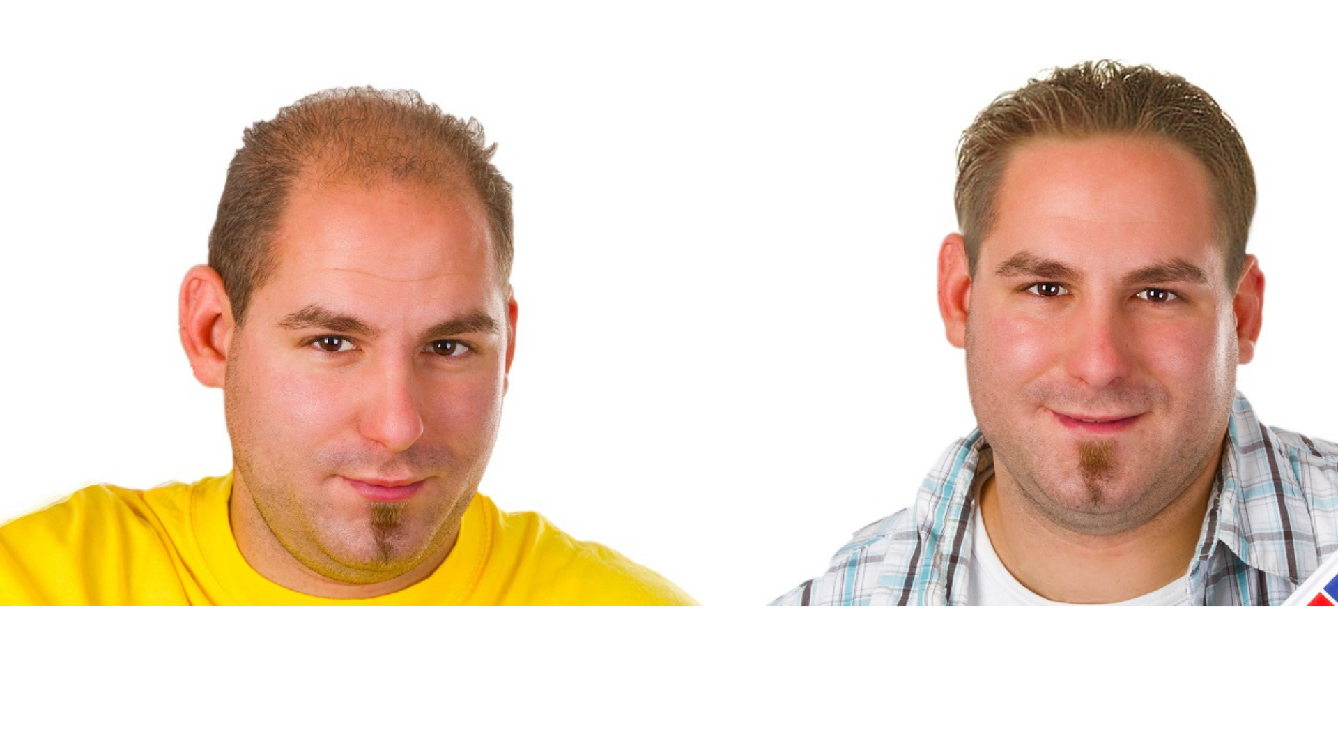 Hair Transplant Before & After — FUEsion Hair Clinics