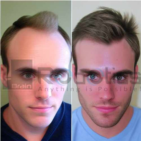 HARRTS FUEsion X Robotic Hair Transplant Before and After Image -20