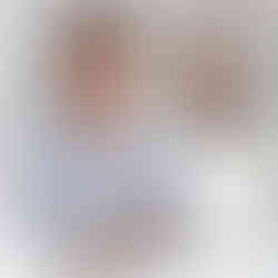 Hair Transplant Before And After at FUEsion Hair Clinics