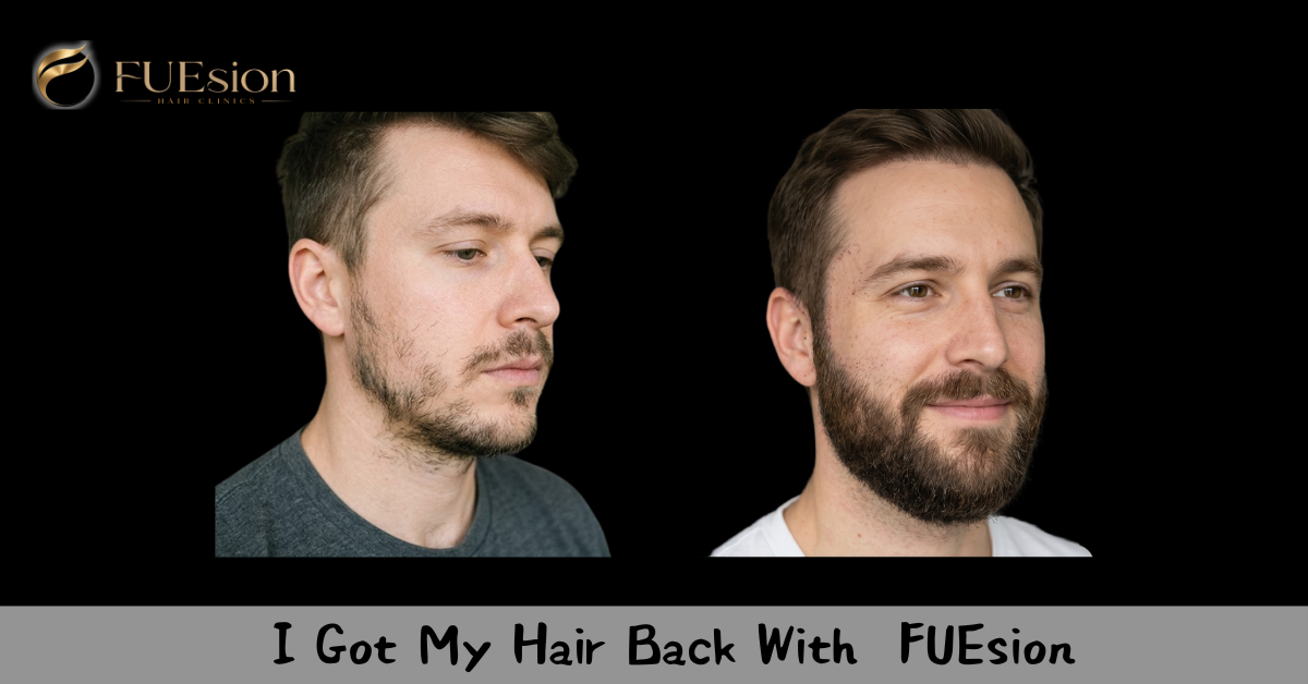 Beard Transplant Before & After — FUEsion Patient