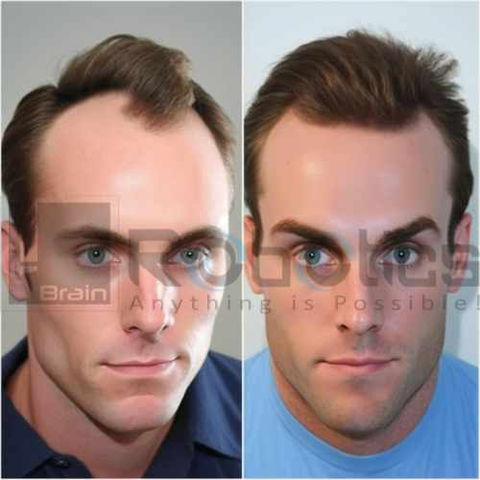 HARRTS FUEsion X Robotic Hair Transplant Before and After Image -6
