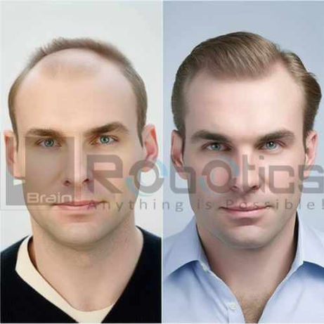 HARRTS FUEsion X Robotic Hair Transplant Before and After Result -10