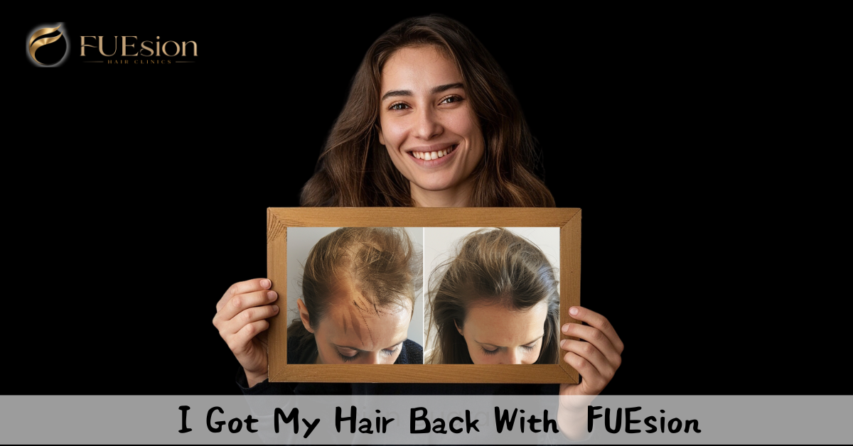 Female Hair Transplant Before & After — FUEsion Patient