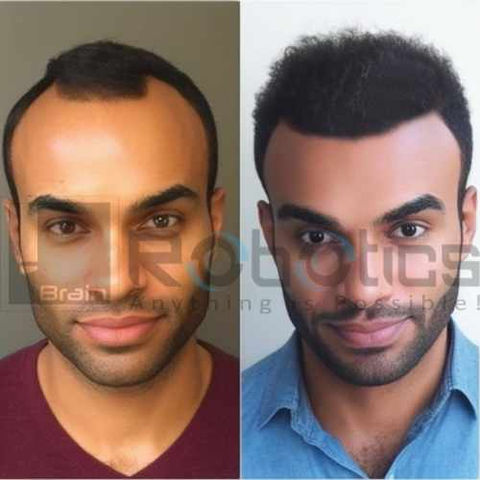 HARRTS FUEsion X Robotic Hair Transplant Before and After Image -2