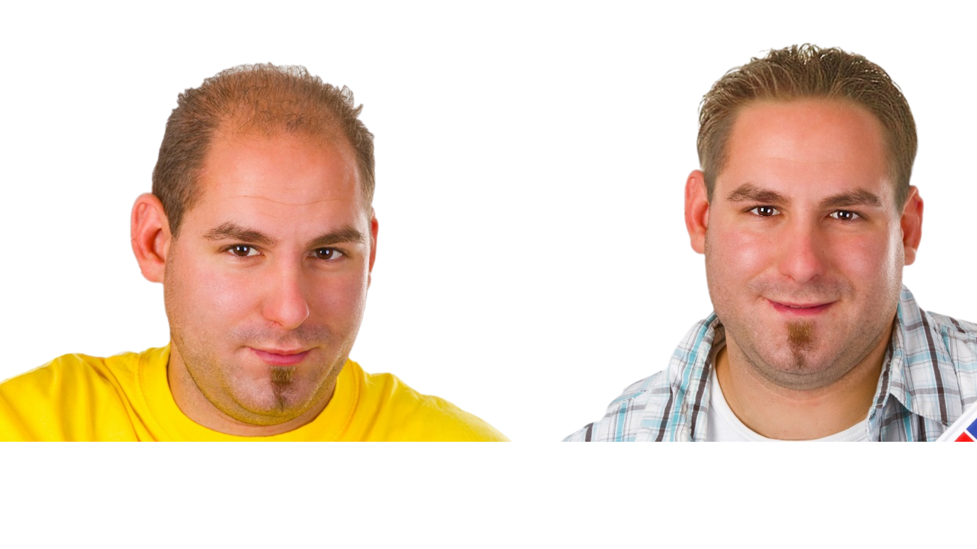 Hair Transplant Before & After — FUEsion Hair Clinics