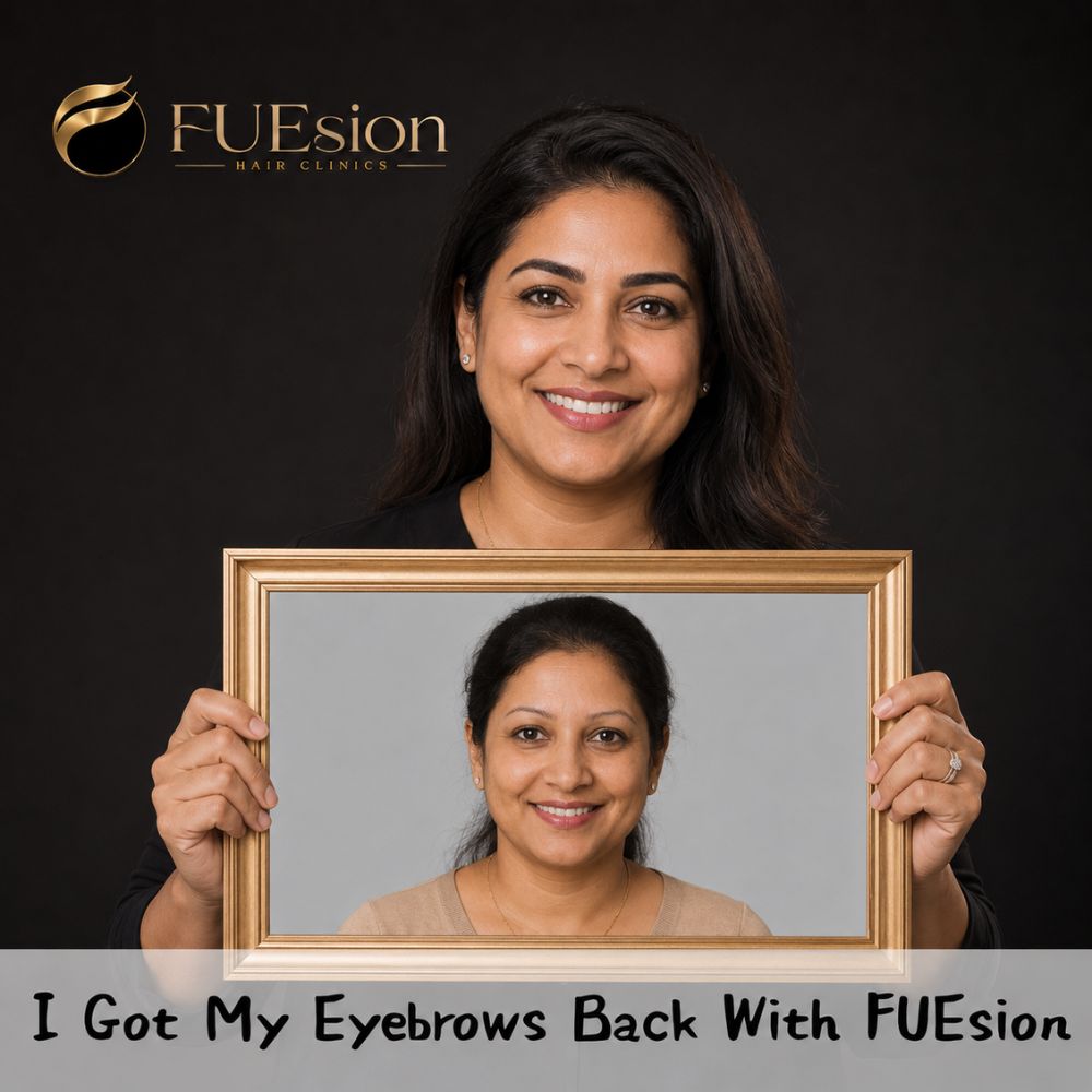 Eyebrow transplant result — FUEsion Hair Clinics