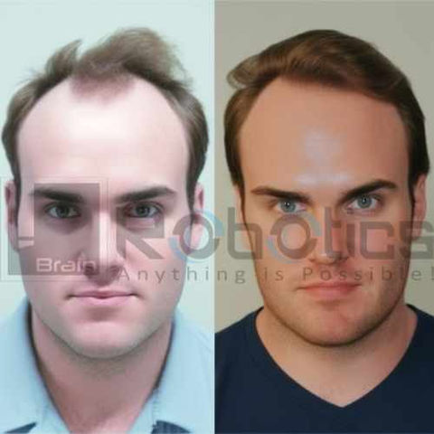 HARRTS FUEsion X Robotic Hair Transplant Before and After Image -18