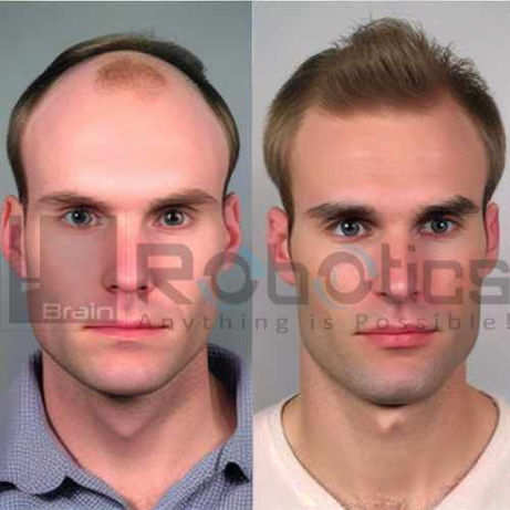 HARRTS FUEsion X Robotic Hair Transplant Before and After Result -11