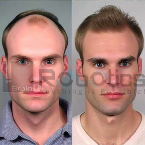HARRTS FUEsion X Robotic Hair Transplant Before and After Image -11