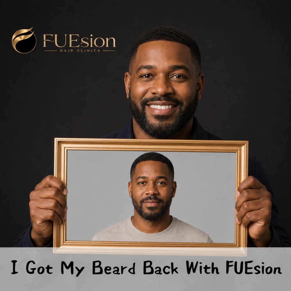 Beard transplant patient result — dense full beard, FUEsion Hair Clinics