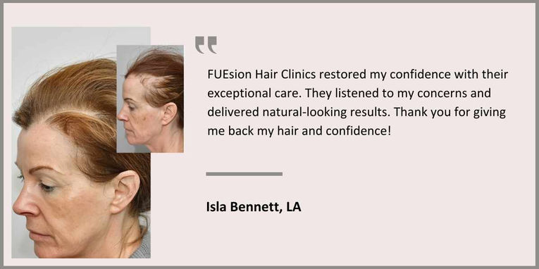 FUEsion Hair Clinics - Female Hair Transplant Testimonial