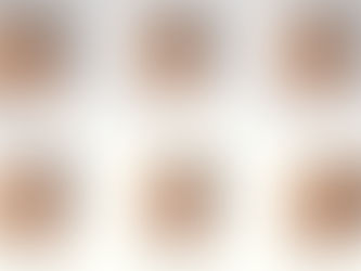 Hair Transplant Density – Achieve Fuller, Natural-Looking Results with FUEsion