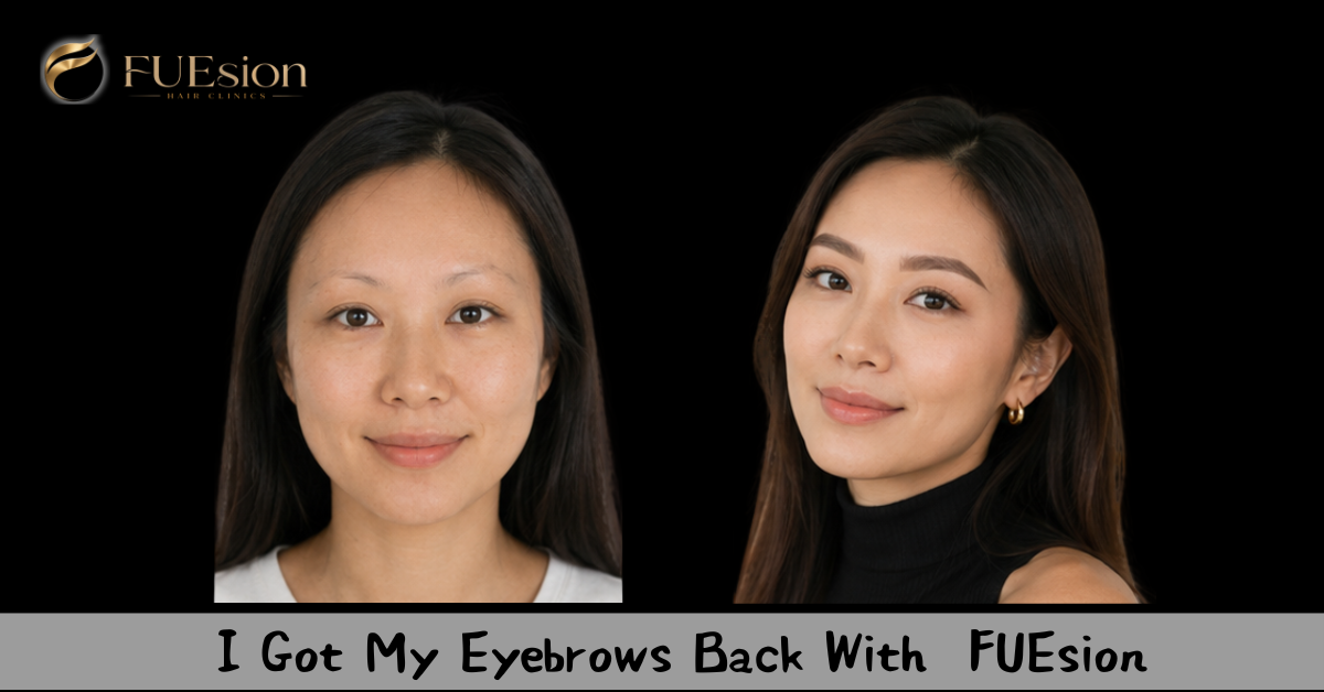 Eyebrow Transplant Before & After — FUEsion Patient