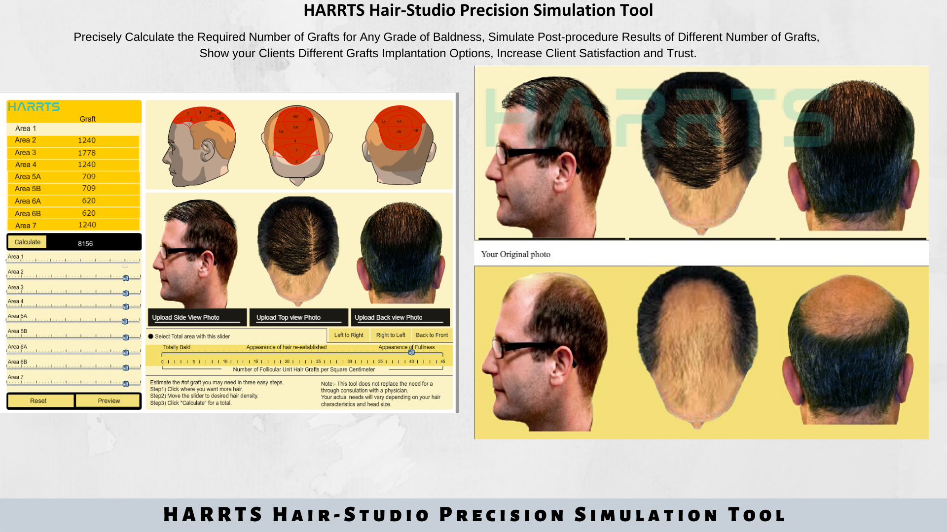 HARRTS Hair Studio | Hair Transplant Results Simulation Tool HARRTS Hair Studio | Hair Transplant Results Simulation Tool