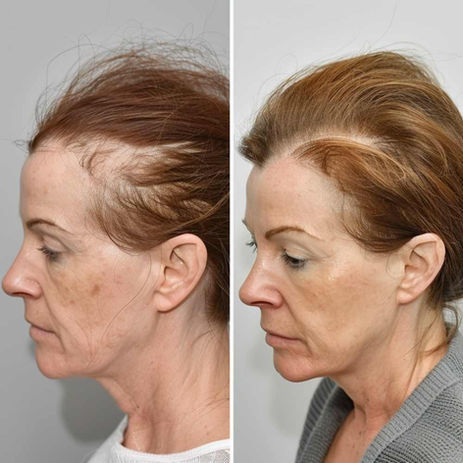 Female Hair Transplant Result Before And After - FUEsion Hair Clinics