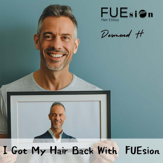 FUEsion Hair Transplant Before And After