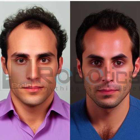 HARRTS FUEsion X Robotic Hair Transplant Before and After Image -22