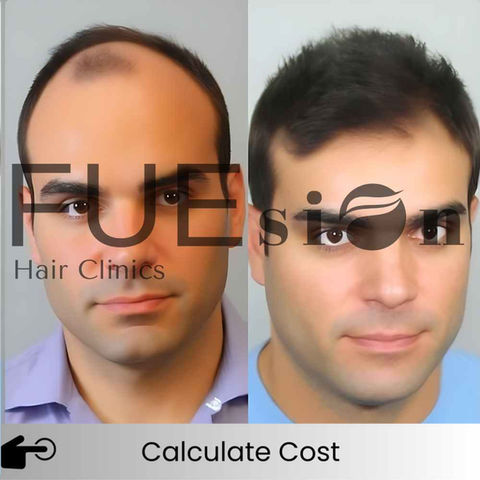 Hair Transplant Before And After -  FUEsion Hair Clinics