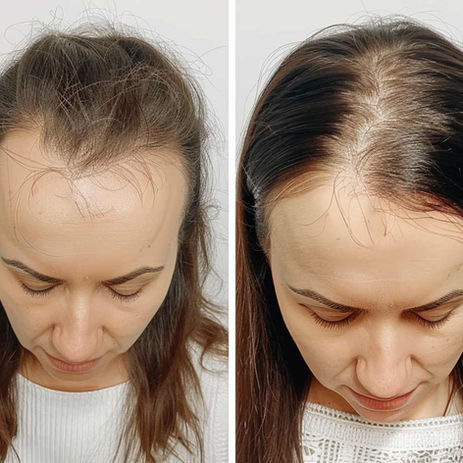 Female Hair Transplant Result Before And After - FUEsion Hair Clinics